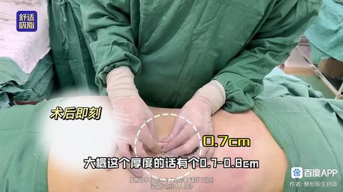 爆料桂哥抽脂视频大全下载,揭秘网红抽脂全过程 第2张 爆料桂哥抽脂视频大全下载,揭秘网红抽脂全过程 第2张