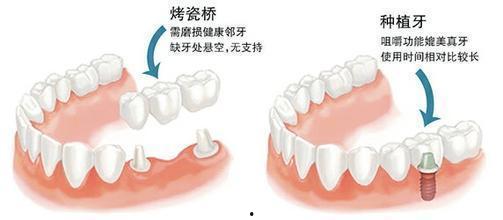 补牙全过程爆料视频大全,从检查到恢复,全方位视频解析 第3张 补牙全过程爆料视频大全,从检查到恢复,全方位视频解析 第3张